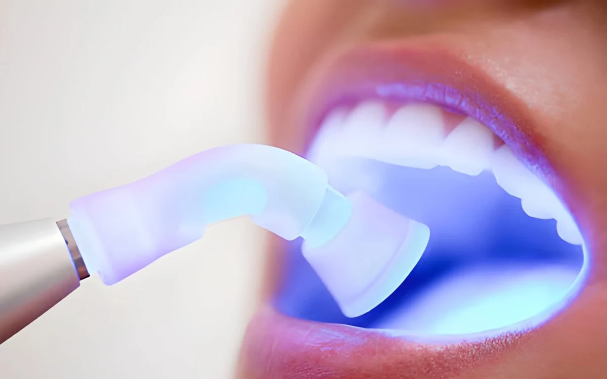 Dental Fillings