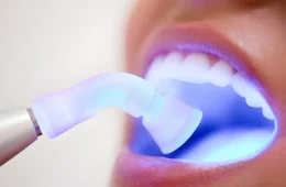 A Complete Guide to Dental Fillings and Composite Bonding for a Flawless Smile