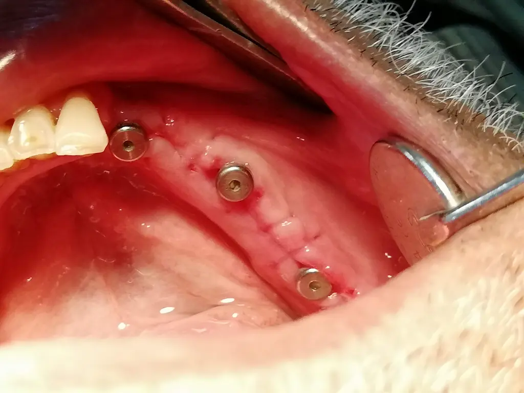 dental implant