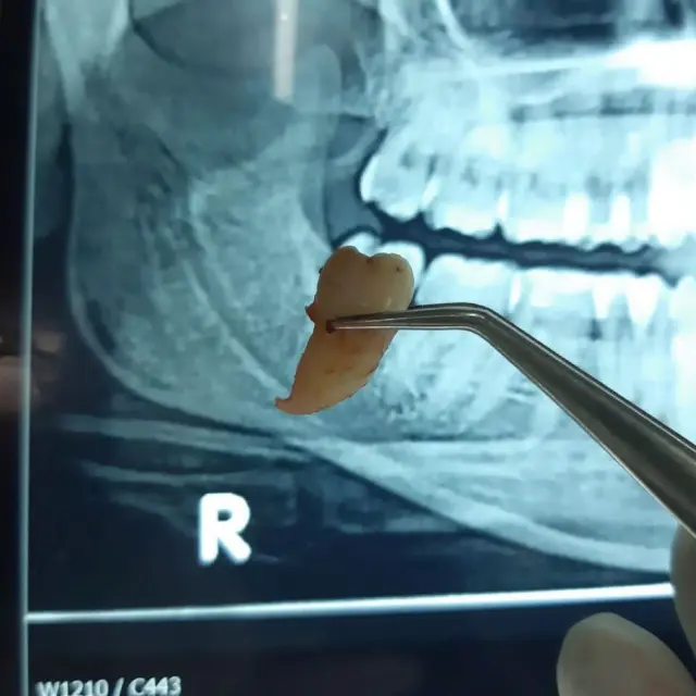 after Wisdom Tooth Removal