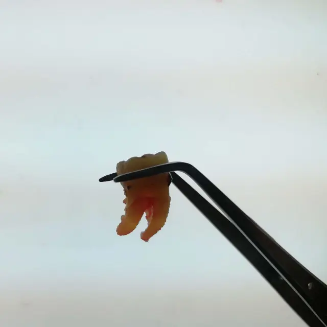 after Tooth Extraction