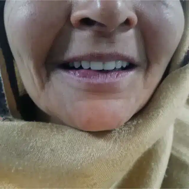 After Dentures