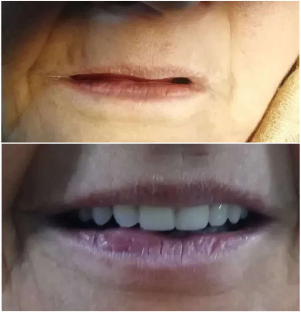 dentures