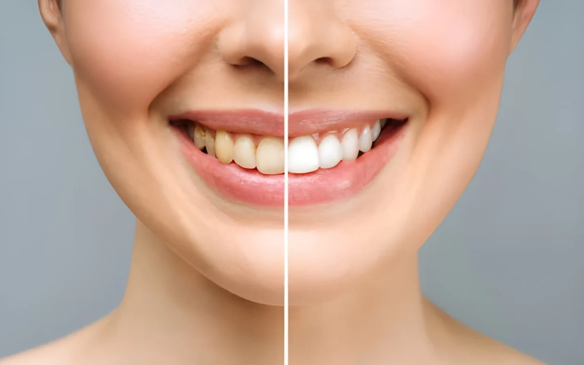 teeth whitening in Islamabad