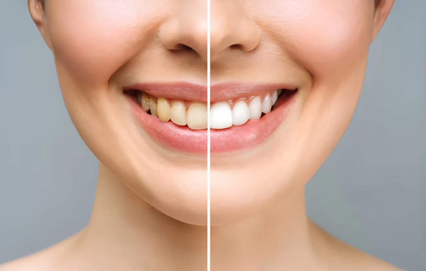 teeth whitening in Islamabad teeth whitening in Islamabad