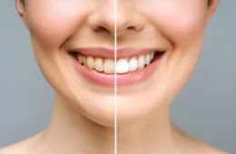 The Ultimate Guide to Professional Teeth Whitening in Islamabad for a Radiant Smile