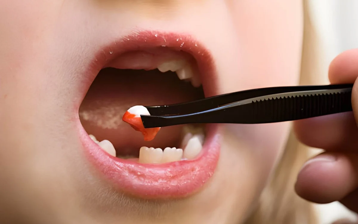 Tooth Extraction In Islamabad