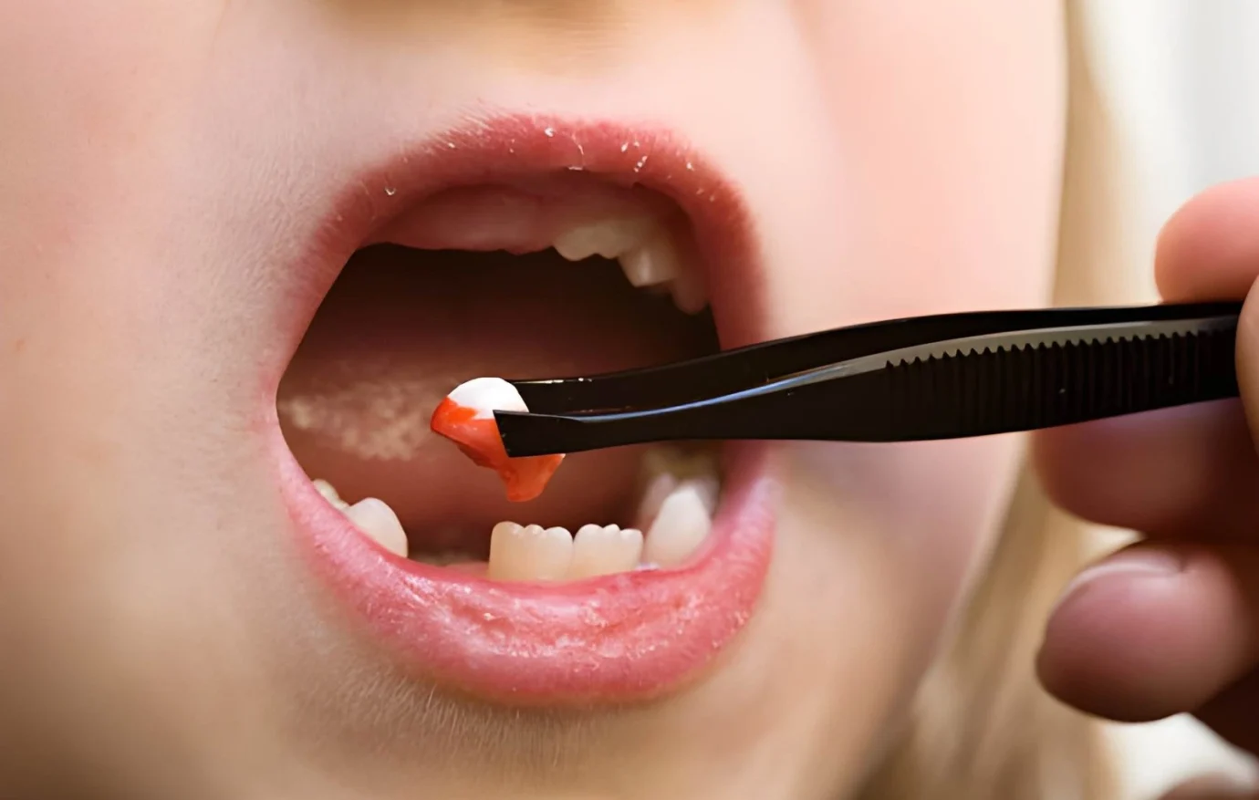 Tooth Extraction In Islamabad Tooth Extraction In Islamabad