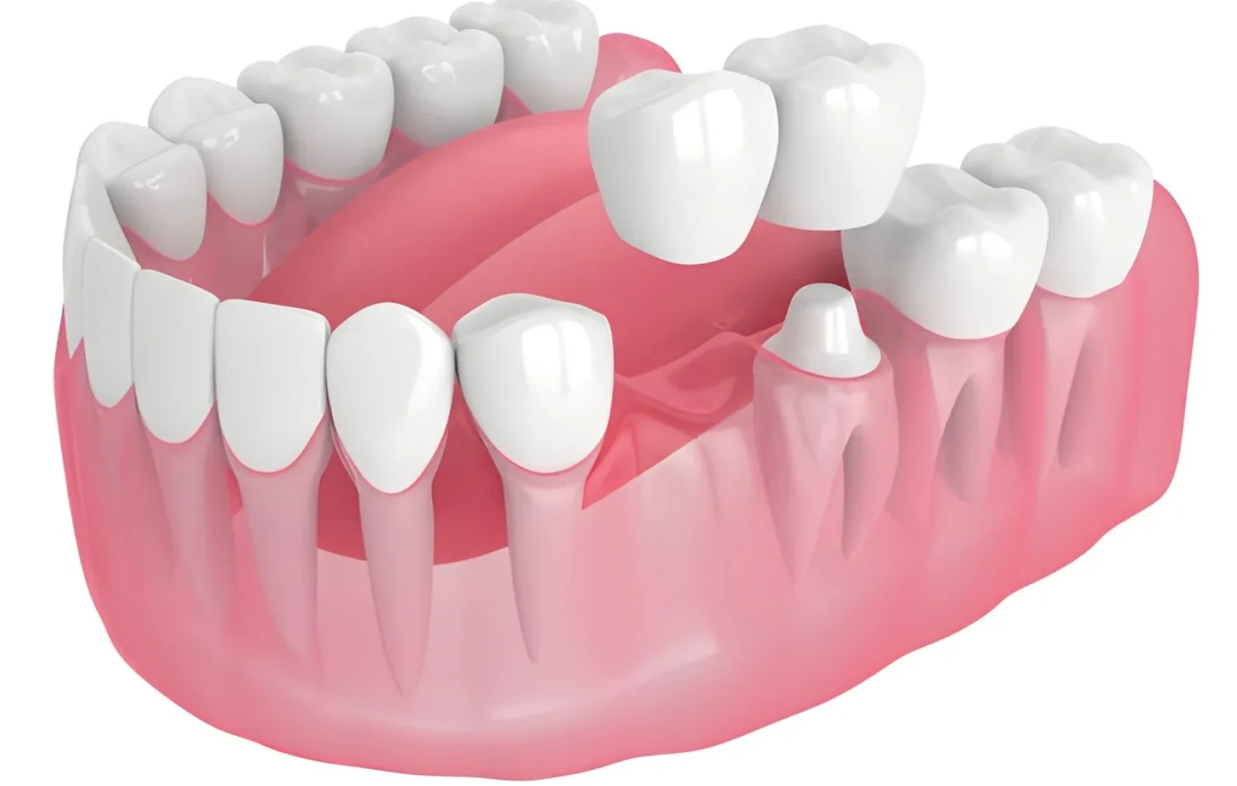 Dental Crowns and Bridges Dental Crowns and Bridges