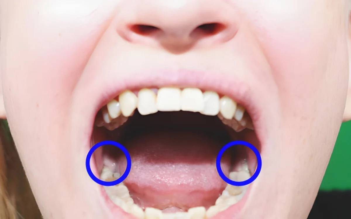 Wisdom Tooth Removal in Islamabad