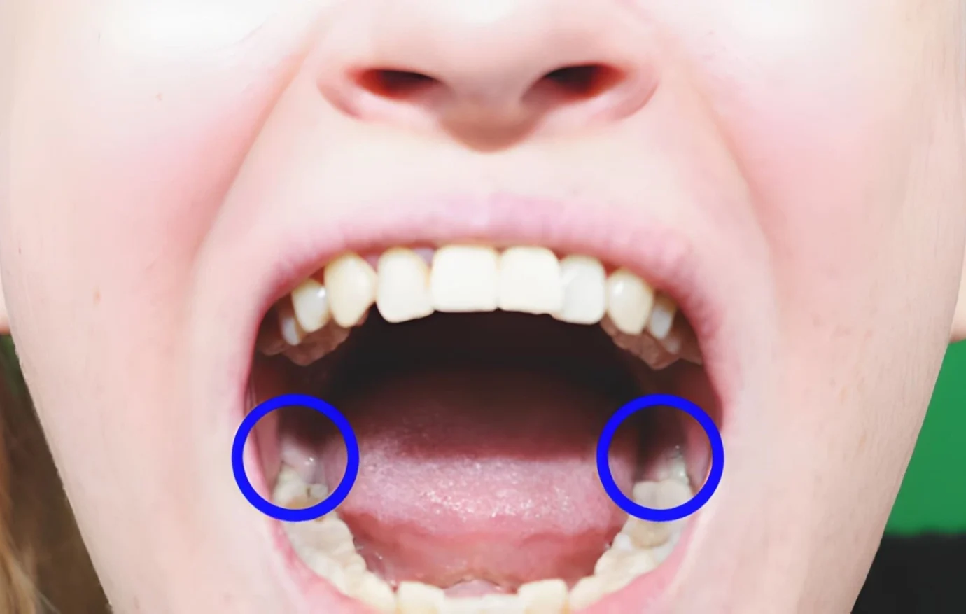 Wisdom Tooth Removal in Islamabad Wisdom Tooth Removal in Islamabad