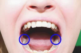 Expert Wisdom Tooth Removal in Islamabad for Complete Pain Relief