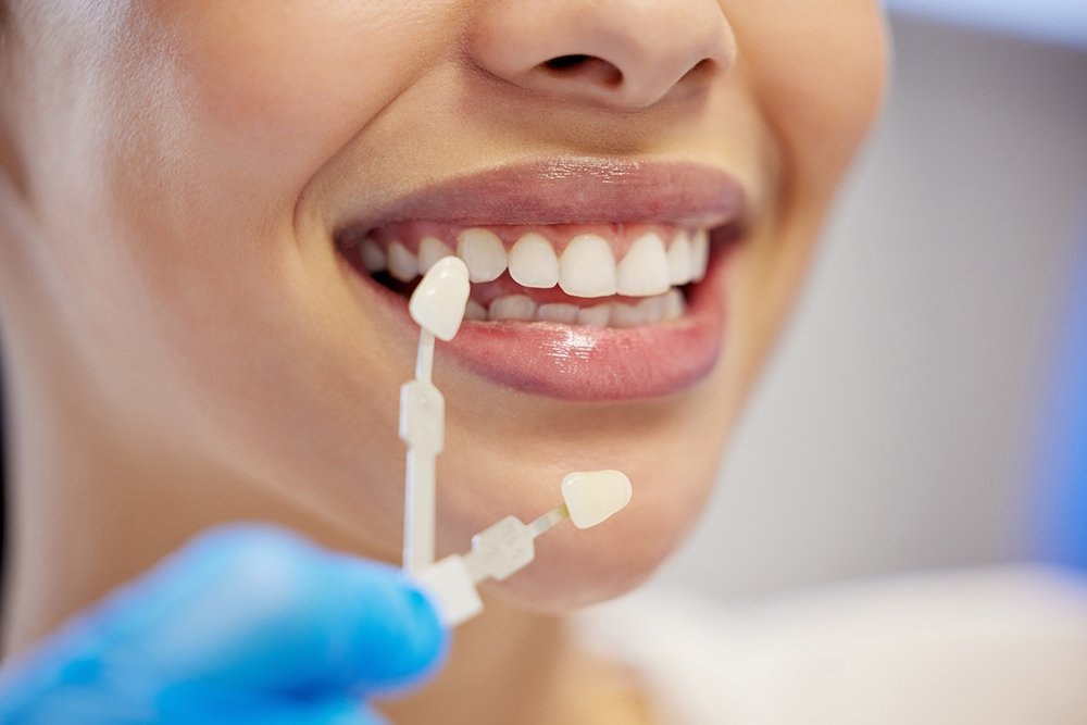 Best Dental Veneers Treatment in Islamabad | The Urban Dentist