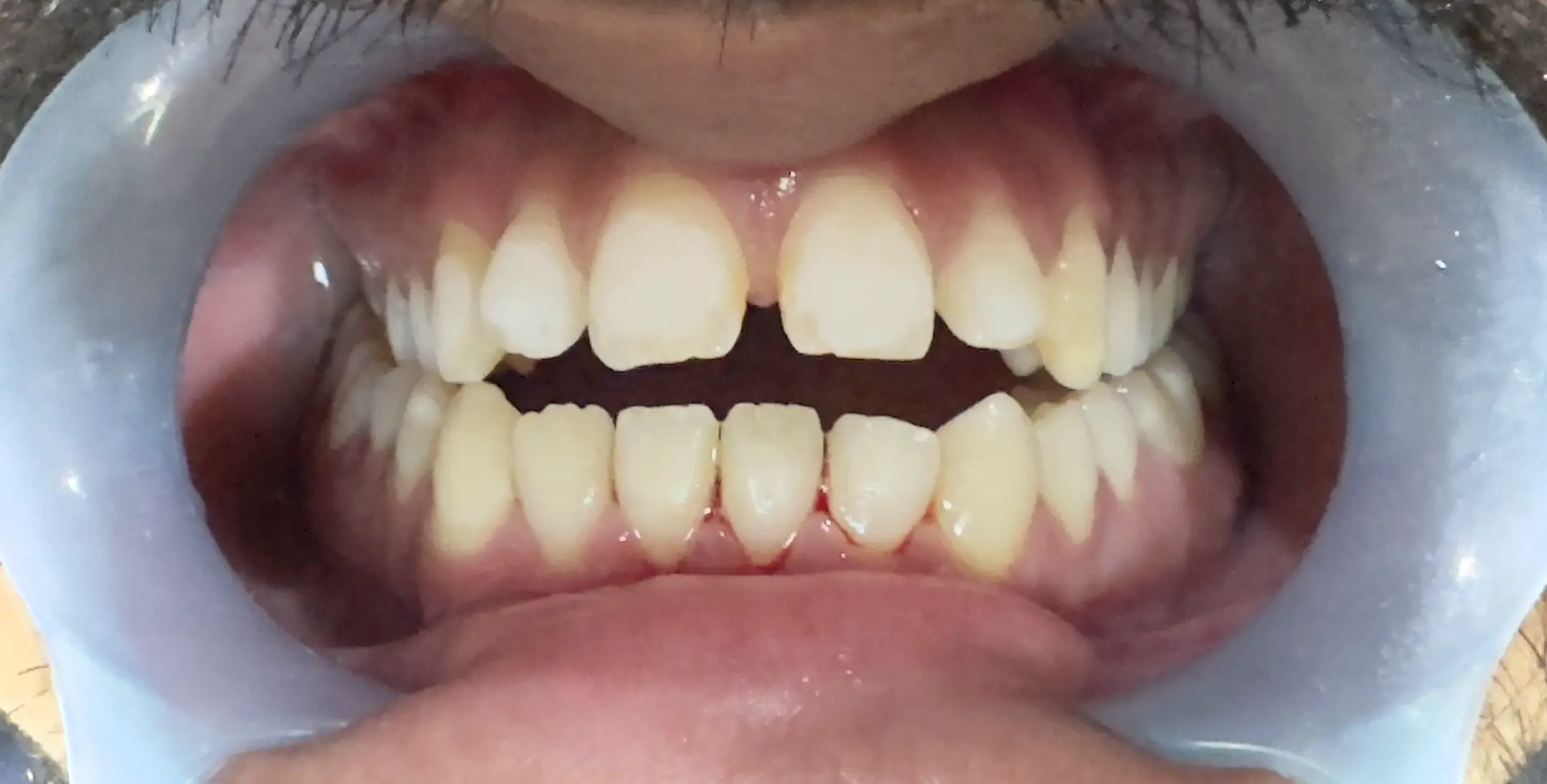 Different types of dental braces including metal, ceramic, and clear aligners in Islamabad clinic